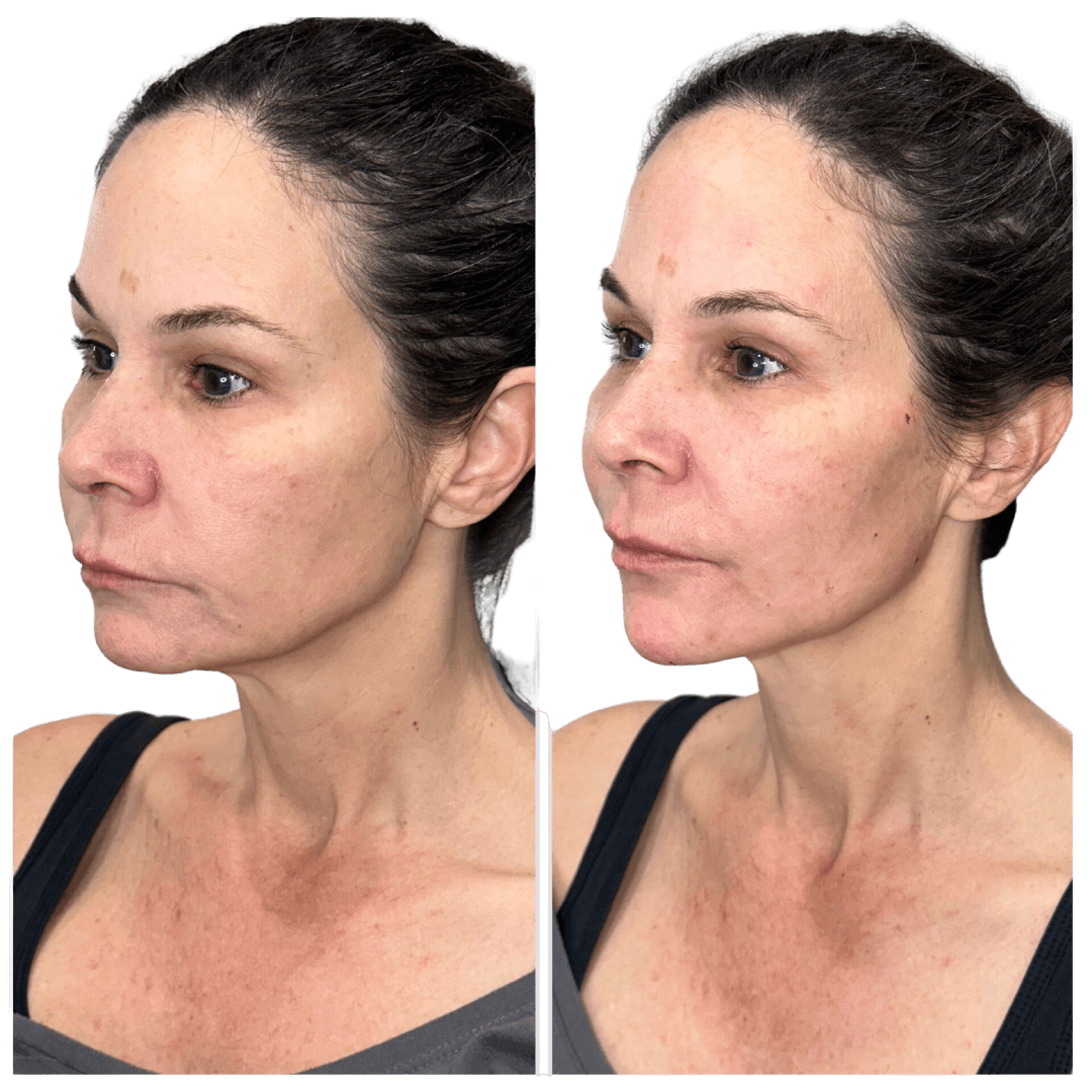 Before and After Gallery  Pura Medical Aesthetics Houston, TX